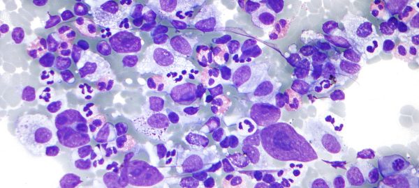 Hodgkin lymphoma